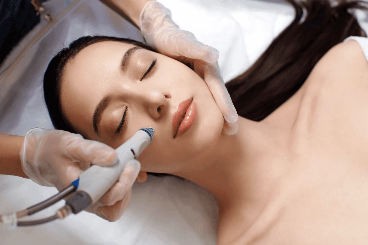 Aplicación de láser dermoestética en cara de mujer